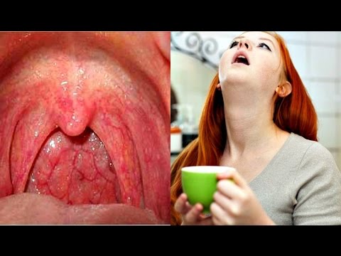 gargarejo com agua oxigenada para garganta inflamada gargarejo com agua oxigenada para garganta inflamada