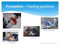 Breast Engorgement With Twins