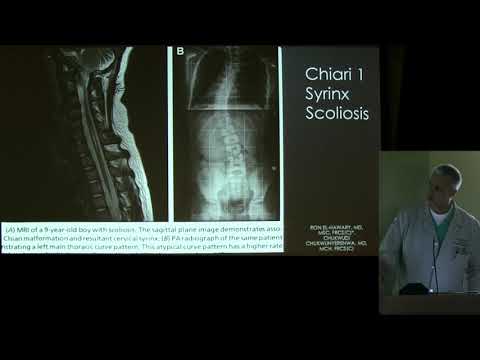 "The Relationship of Chiari, Syrinx & Scoliosis: An Update" - John Ruge, MD