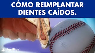 Avulsión dental - Cómo reimplantar un diente caído