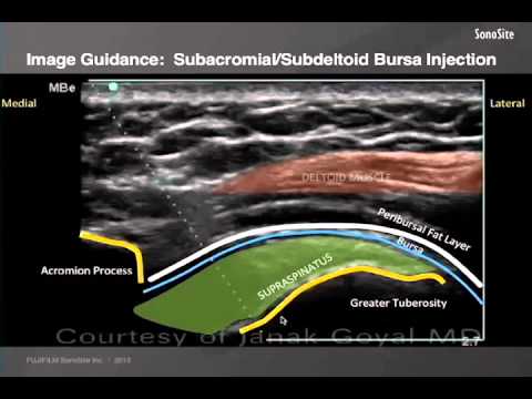 Webinar: Ultrasound-Guided Shoulder Injections Part 1
