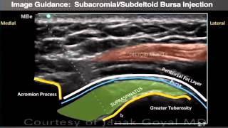 Webinar: Ultrasound-Guided Shoulder Injections Part 1