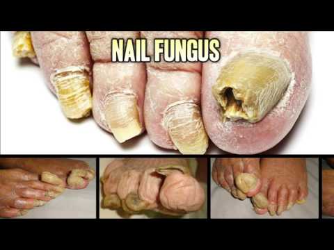 Nail Fungus, Blackheads & Popping - All Star Medical Trailer
