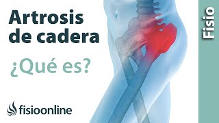 ¿Qué es la artrosis de cadera?