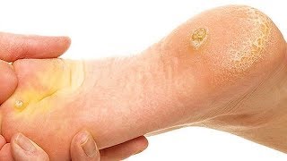 How to Get Rid of Calluses on Feet Overnight.