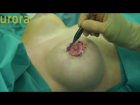Areola Reduction Procedure - Aurora Clinics