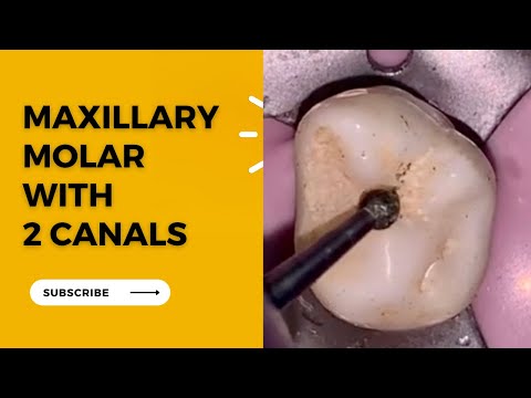 Maxillary Molar Access Opening