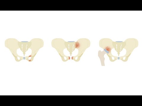 Investigating pelvic fractures on CT