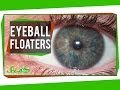 Those Maddening Eyeball Floaters