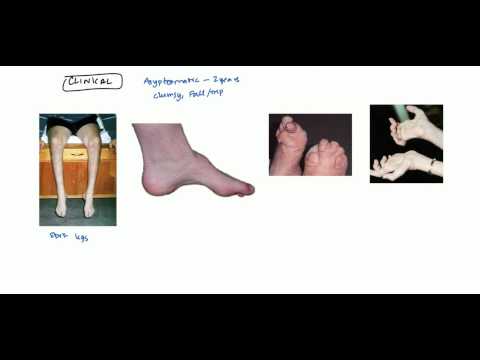 Charcot Marie Tooth Syndrome for USMLE