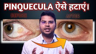 How To Remove Pinquecula (सबसे आसान उपाय)| Lokesh Dixit