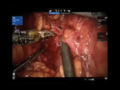 Robotic-Assisted Partial Nephrectomy In Case Of Single Kidney