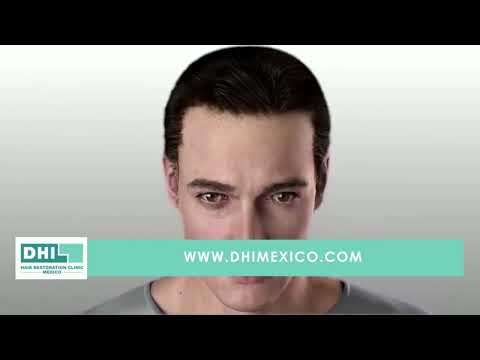 Aquí nuestra técnica DHI (Direct Hair Implant) y cómo funciona!!