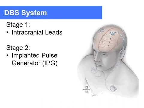 CNS Neurosurgery 100: Parkinson's Disease