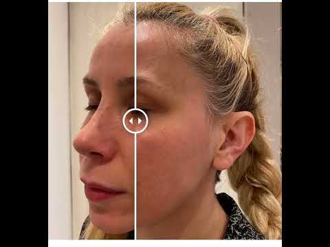 Lip Filler