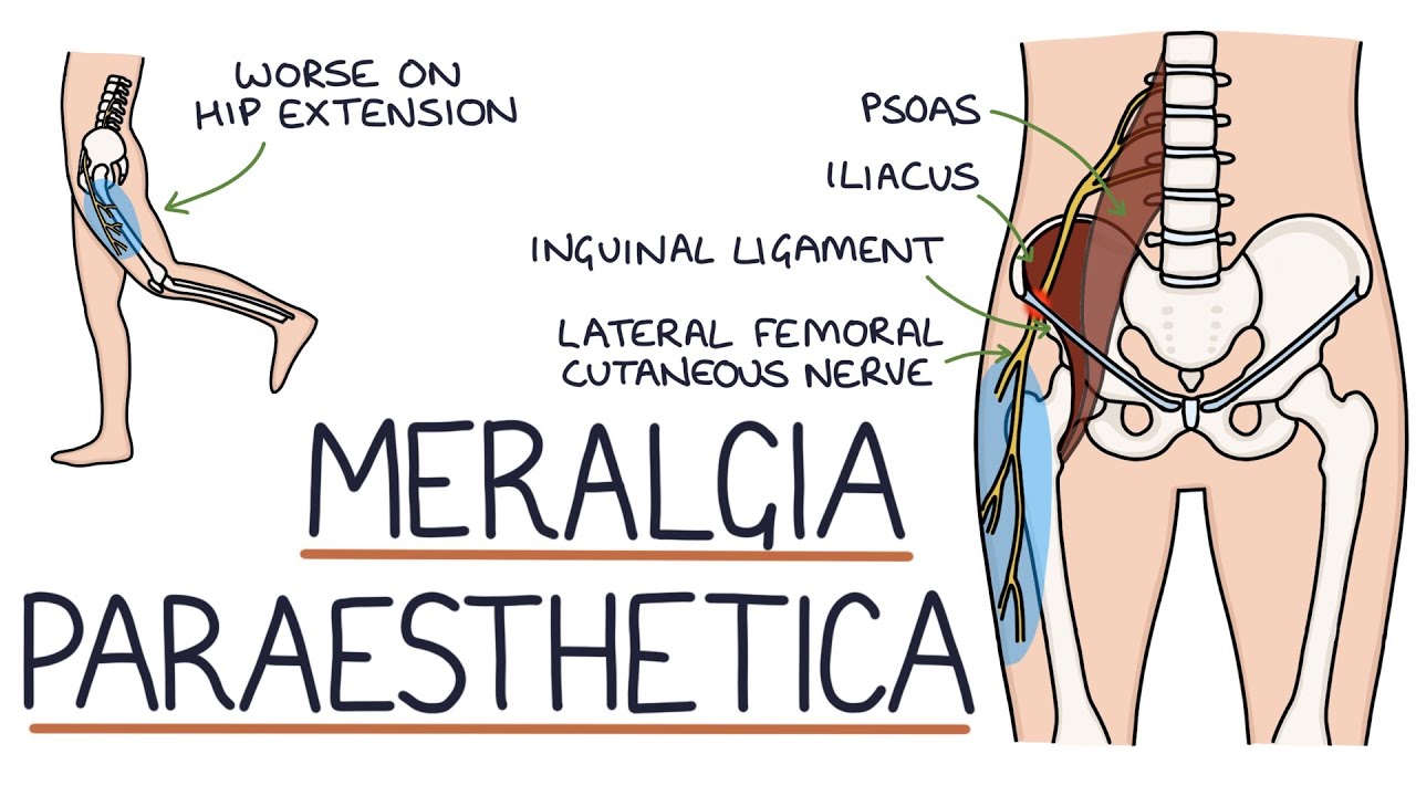 Understanding Meralgia Paraesthetica