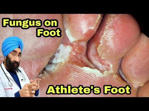 Athlete's foot | Fungal Foot Infection | Tinea pedis | 100% Science | Dr.Education (ENG)