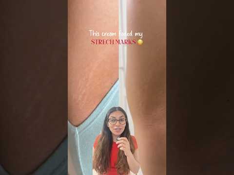 Best cream for strech marks 🥳 | Tried and tested 😍 #strechmarks #skincare #shortsvideo