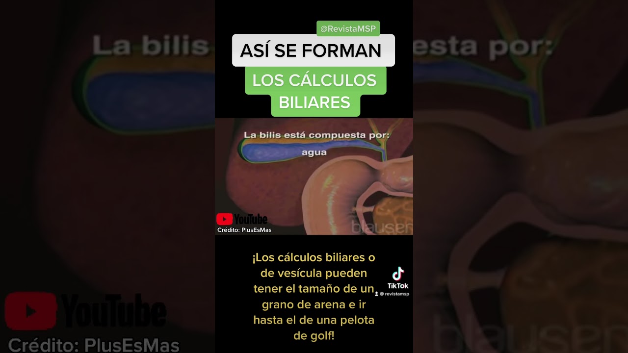 ASÍ SE FORMAN LOS CÁLCULOS EN LA VESÍCULA - GALLSTONES/COLELITIASIS