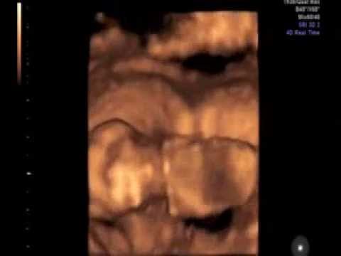 Apparecchi per la riabilitazione dellarticolazione del gomito Come fasciatura al gomito