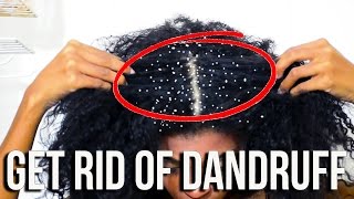 How To Get Rid Of Dandruff Fast!
