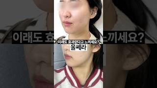흐릿한 턱선 울쎄라로 바로 잡기✅