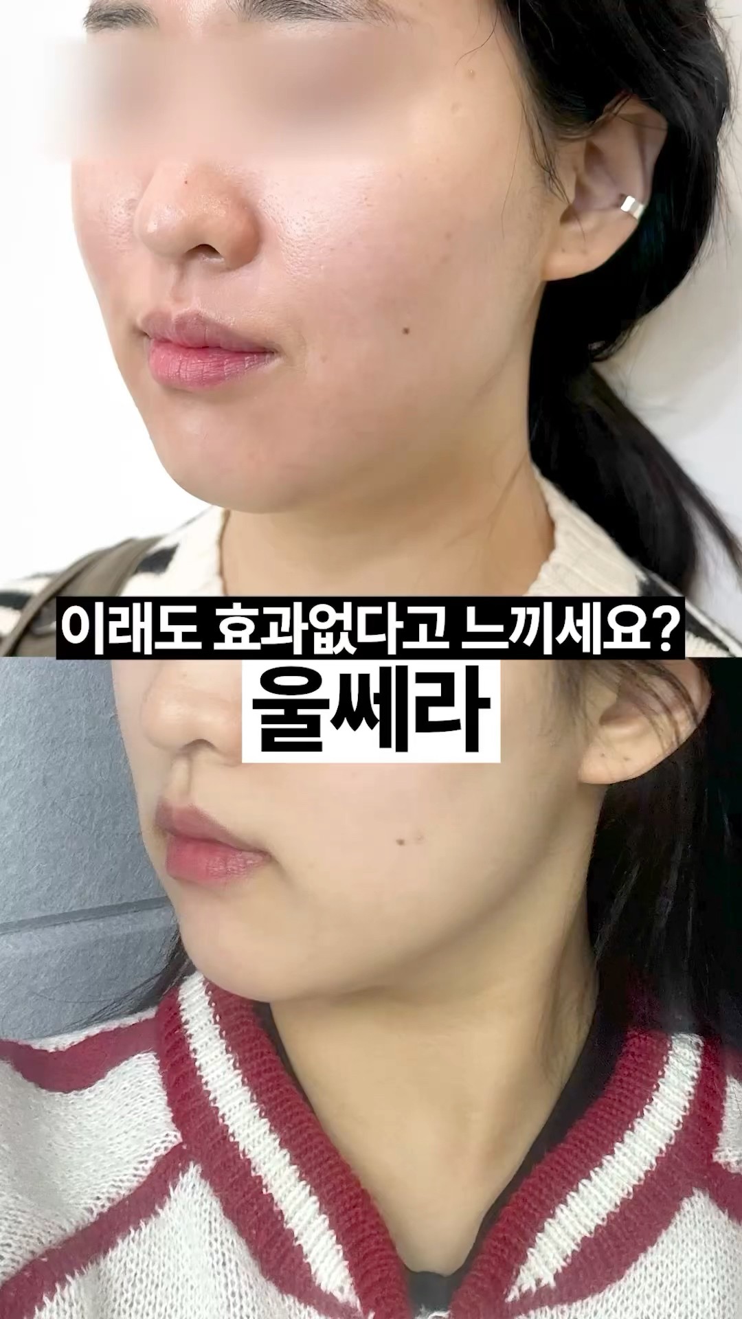 흐릿한 턱선 울쎄라로 바로 잡기✅