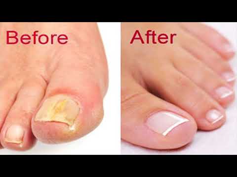 Kung ito ay posible upang pagbatayan suka halamang-singaw sa daliri ng paa kuko Rubromikoz nail treatment