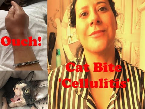 CAT  BITE  ' CELLULITIS'  MY STORY!