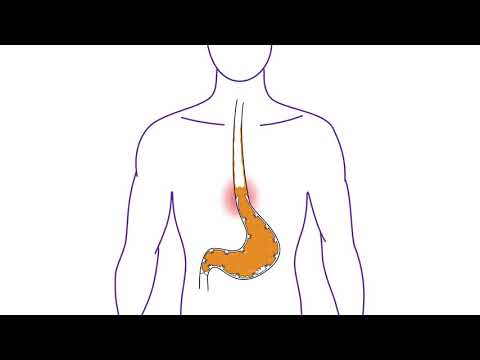 Nexium Control® - What is Heartburn?