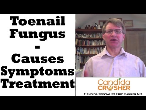 Fluconazole sa paggamot sa fungal kuko sa paa review Kung paano sa pagalingin halamang-singaw sa kuko ng kamay ekzoderil