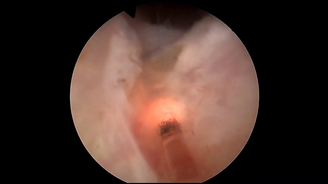 DiLEP - diode laser enucleation of the prostate