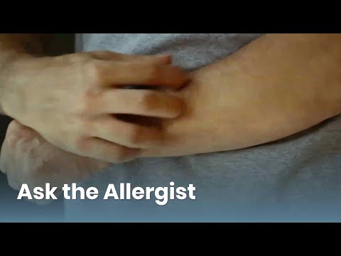 Chronic Hives Triggers and Treatment: Ask the Allergist (Chronic Urticaria)