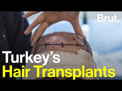 Hair transplant tourism in Turkey