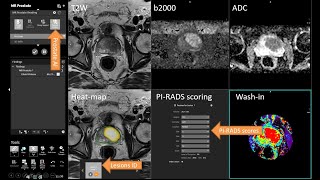 Using AI for Prostate Cancer Detection - case-based review