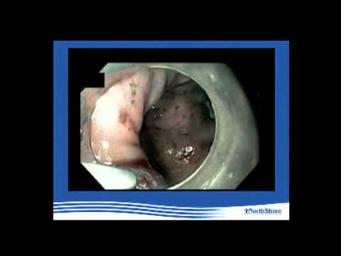 Die gastroskopische Miotomie in Behandlung von Achalasie der Speiseröhre