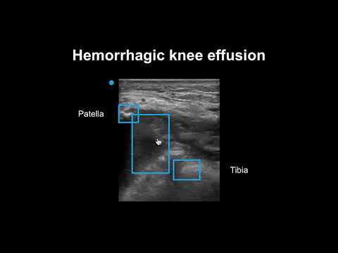 How to detect joint effusions with ultrasound