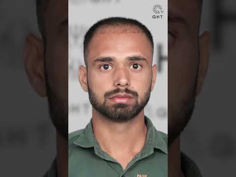 Seven Months Hair Transplant Results | Latest Fue Technique #shorts #viral #hair transplant