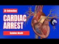 Cardiac Arrest (Sudden Death) - 3D Animation