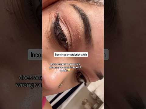 🛑 stop using these 4 things if you have eyelid eczema #eczema #eyelid