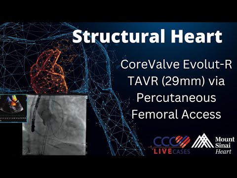 CoreValve Evolut-R TAVR (29mm) via Percutaneous Femoral Access - Structural Heart Feb 2016 Webcast