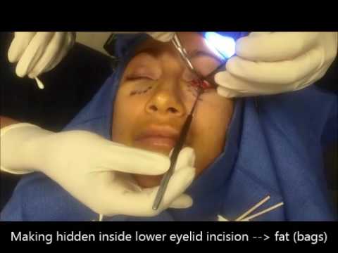 Patient Testimonial – Izabelle – Lower Blepharoplasty (Lower Eyelid Surgery) For Eye Bag Removal Patient Testimonial – Izabelle – Lower Blepharoplasty (Lower Eyelid Surgery) For Eye Bag Removal