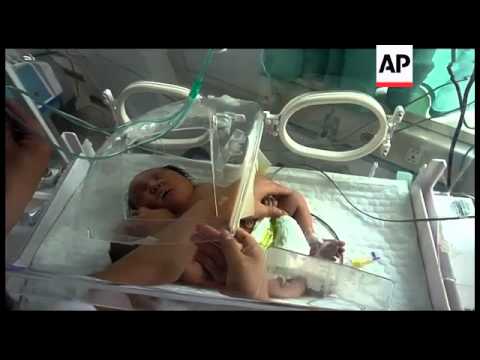 Chinese conjoined twins in hospital