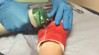 CUTTING OFF MY CAST!!