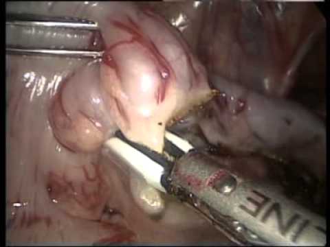 Laparoscopic Assisted Anorectal Pull-Trough for Hirschsprung Disease in a 12 Months Old Boy