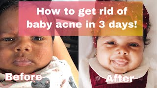 How to get rid of Baby Acne in under 3 days