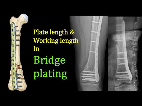 Bridge Plating Distal Femur: Ideal Length?