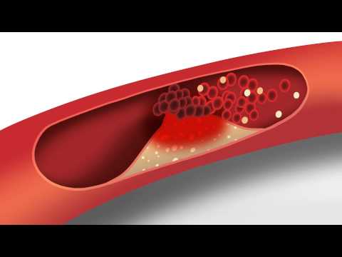 Cholesterol animation | Heart disease risk factors