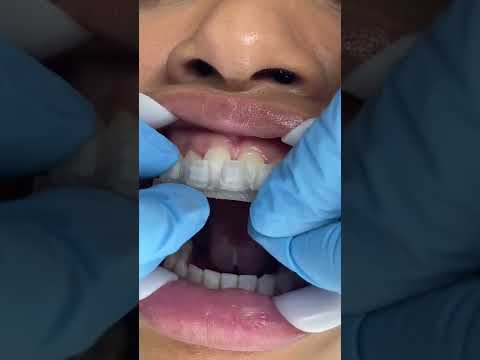 Putting 3D Printed Custom LightForce Braces On