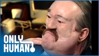 His Face Was Deformed by Flesh- Eating Fungus | Now He Has Eyes and Nose Again